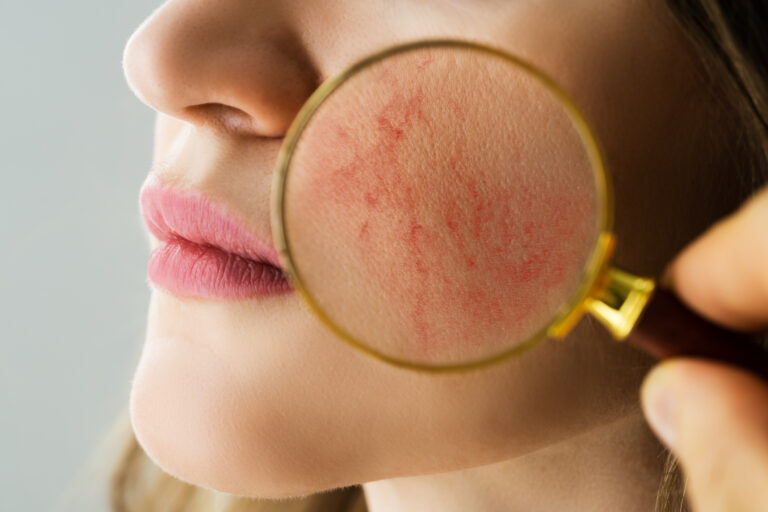 3 breakthroughs that could treat skin redness