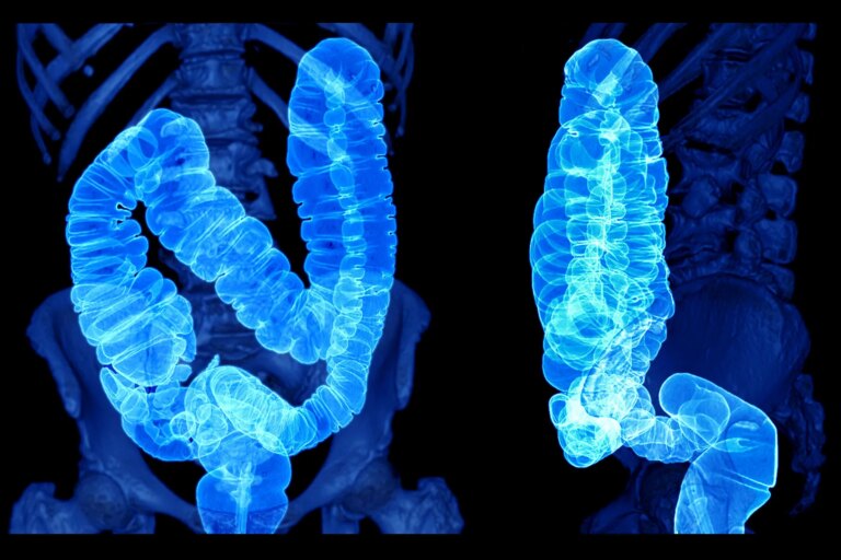1800ss getty rf ct scan of colon